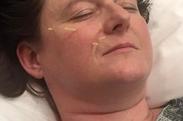 Dry needling on the face