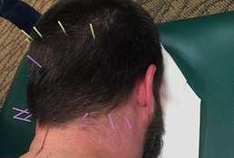 Dry needling of the back of head