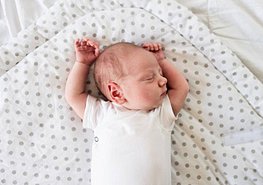 Infant with torticollis sleeping